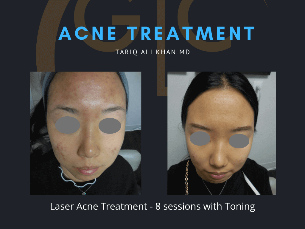 Gentle Care Laser Tustin & Long Beach Before and After picture - Acne Laser treatment